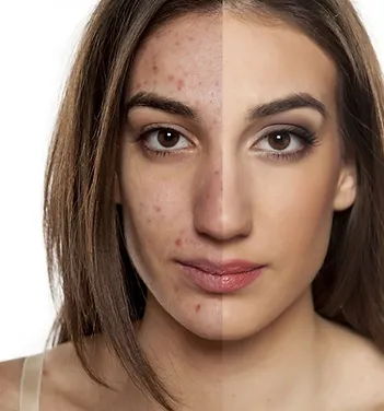 Acne Before and After Treatment | Newport Cove Dermatology in Newport Beach, CA