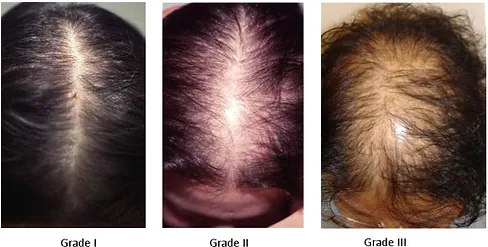A Collage of Medical Alopecia | Newport Cove Dermatology in Beautiful Woman Getting a Facial Treatment | Newport Cove Dermatology in Newport Beach, CA