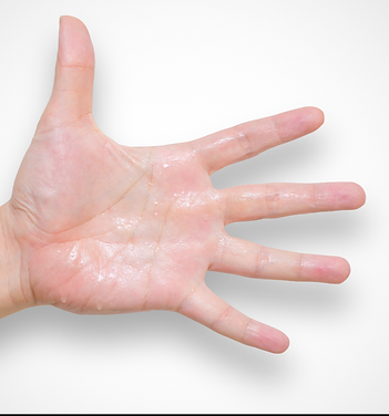 Wet Hand | Newport Cove Dermatology in Close up of Rashes on Skin | Newport Cove Dermatology in Newport Beach, CA