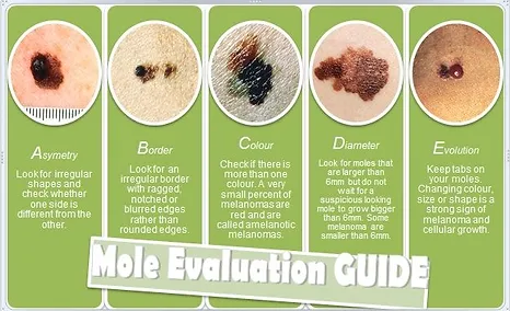 Mole Evaluation Guide | Newport Cove Dermatology in Newport Beach, CA
