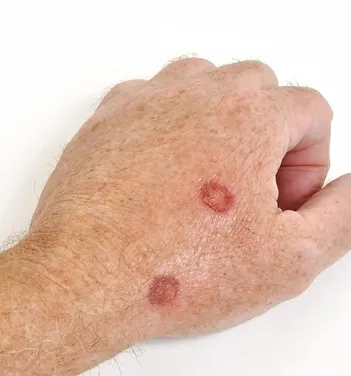 Precancerous Lesions on Hand | Newport Cove Dermatology in Newport Beach, CA