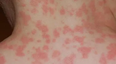 Close up of Rashes on Skin | Newport Cove Dermatology in Newport Beach, CA