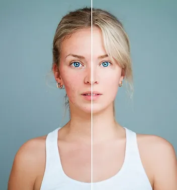 Rosacea Before and After Treatment | Newport Cove Dermatology in Newport Beach, CA