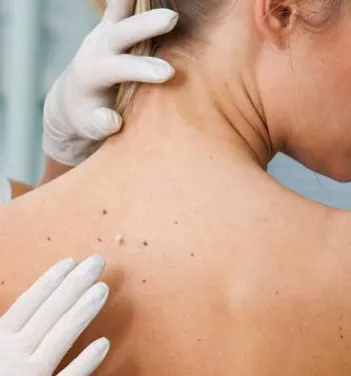 Woman's Back with Skin Cancer | Newport Cove Dermatology in Newport Beach, CA