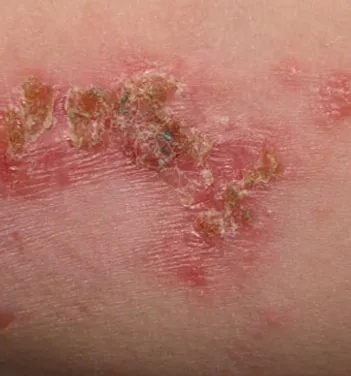 Skin Infections on Skin | Newport Cove Dermatology in Newport Beach, CA