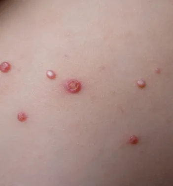 Warts on Skin | Newport Cove Dermatology in Newport Beach, CA