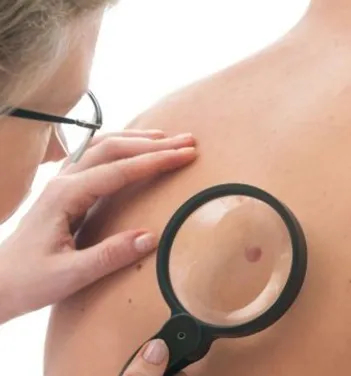 Doctor Examining a Mole Using Magnetic Glass on a Person's Back | Newport Cove Dermatology in Newport Beach, CA
