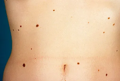 A Close-up of a Person's Mole on Stomach | Newport Cove Dermatology in Newport Beach, CA