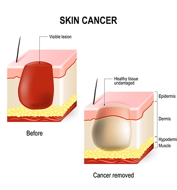 A Diagram of Skin Cancer | Newport Cove Dermatology in Newport Beach, CA