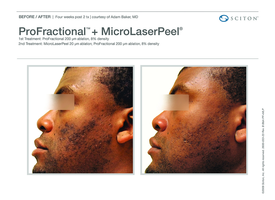 Newport-Profactional-Laser-Before-After-Images-Newport-Beach-right-view
