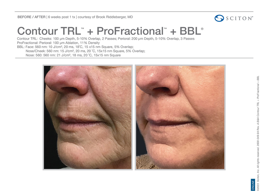Newport-Profactional-Laser-Before-After-Images-couter-Newport-Beach
