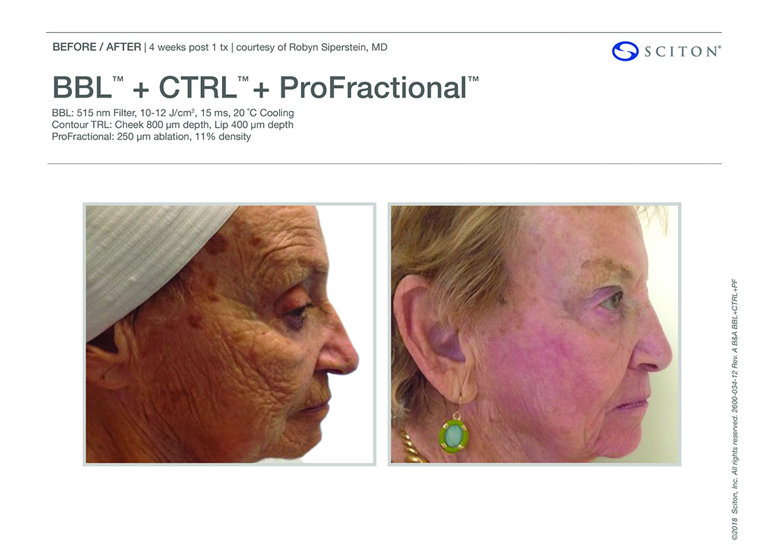Newport-Profactional-Lasers-Before-After-Images-Newport-Beach