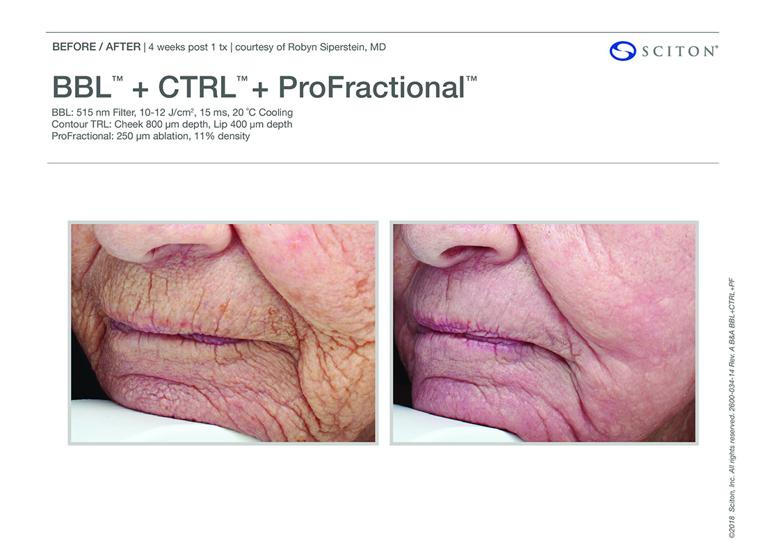 Newport-Profactional-bbl-Laser-Before-After-Images-Newport-Beach-one