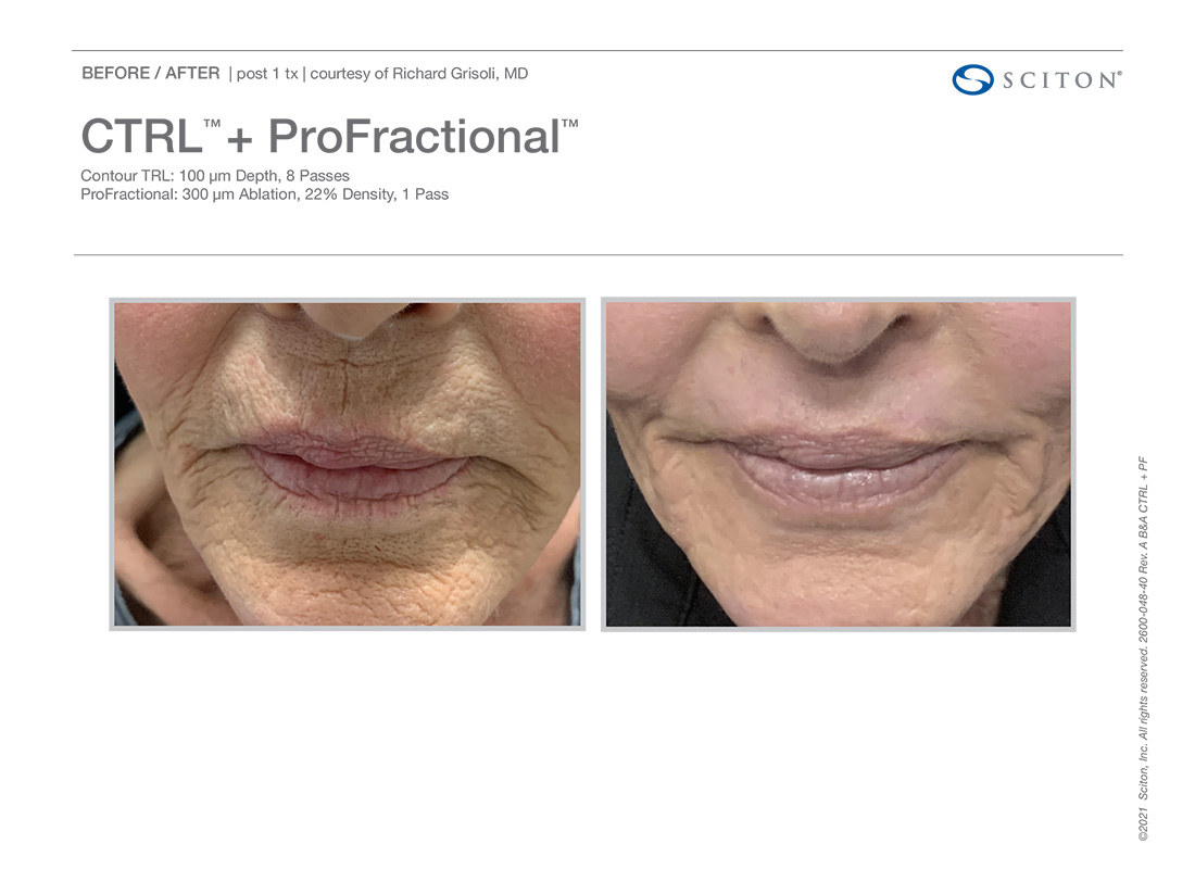 Newport-Profactional-ctrl-Laser-Before-After-Images-Newport-Beach-one