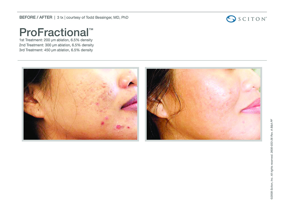 Profactional-Laser-Before-After-Images-Newport-Beach